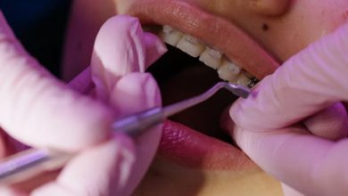 things-to-consider-before-getting-braces